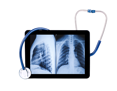 X-ray showing a person's ribcage from the front and side on a tablet with a stethoscope wrapped around it